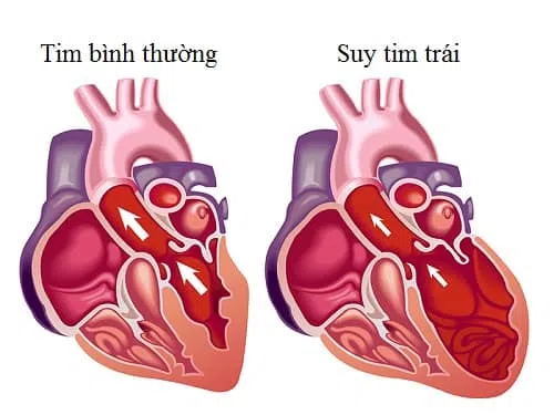 Cơ chế suy tim