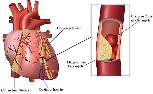 Mối ác hại của bệnh mạch vành
