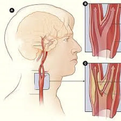 Các mảng xơ vữa ở động mạch cảnh