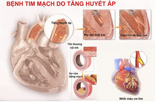 BS khuyến cáo: Người cao huyết áp tuyệt đối không làm điều này kẻo đột quỵ mất mạng có ngày - Ảnh 3.