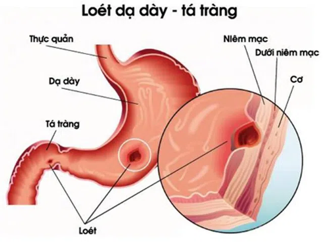 Điều trị loét dạ dày tá tràng