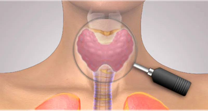 Bệnh tuyến giáp là gì?