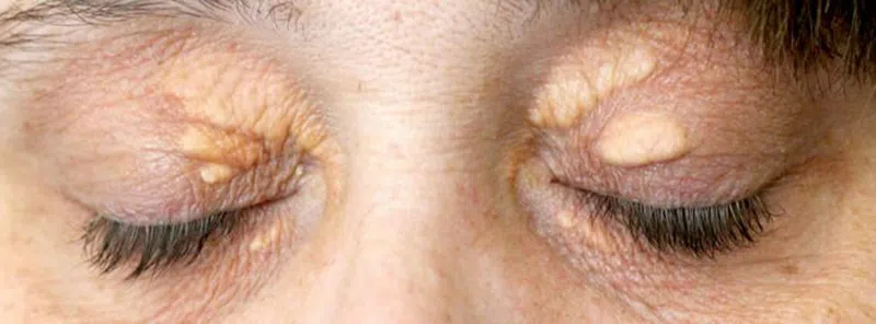 u vàng ở vùng da quanh mắt