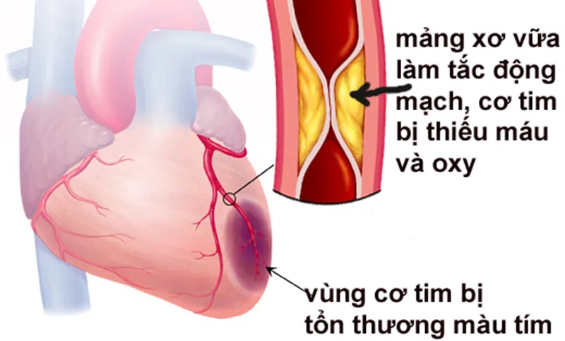 Nguyên nhân nhồi máu cơ tim