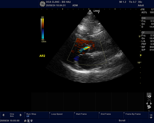 Làm thế nào để thực hiện siêu âm Doppler tim đáng tin cậy theo từng bước